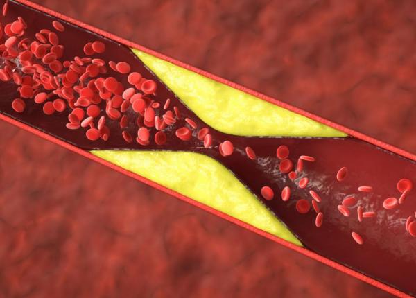 boala care evolueaza in tacere cum iti dai seama ca arterele tale sufera