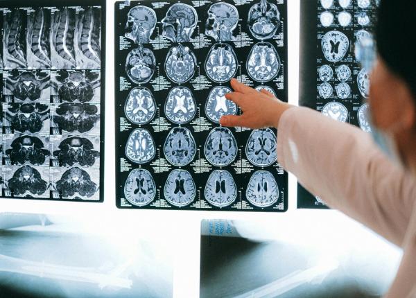 5 semne ascunse ale tumorii cerebrale pe care multi le ignora sfatul neurochirurgilor